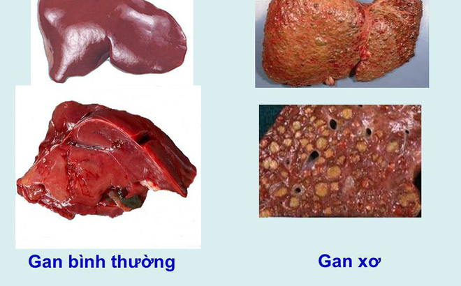 Bệnh xơ gan cổ trướng sống được bao lâu 