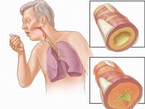 Bị ho đờm không nên ăn gì để bệnh nhanh khỏi 