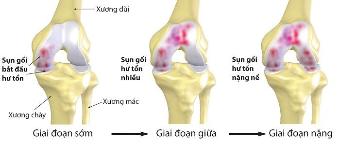 Bị khô khớp nên uống thuốc gì hiệu quả an toàn