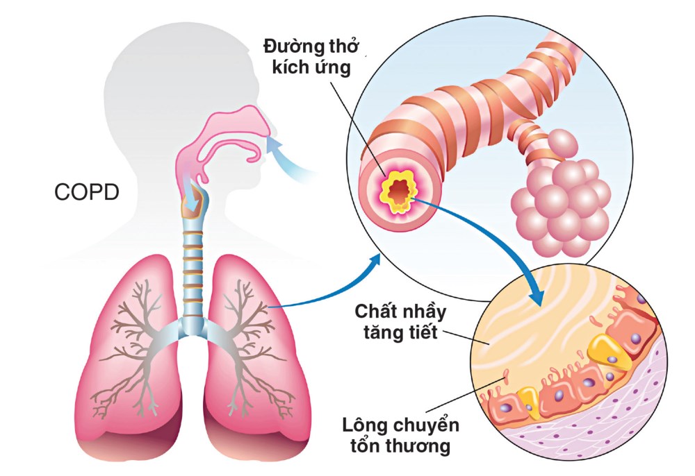  Bị khó thở là triệu chứng của bệnh gì và cách phòng bệnh ra sao