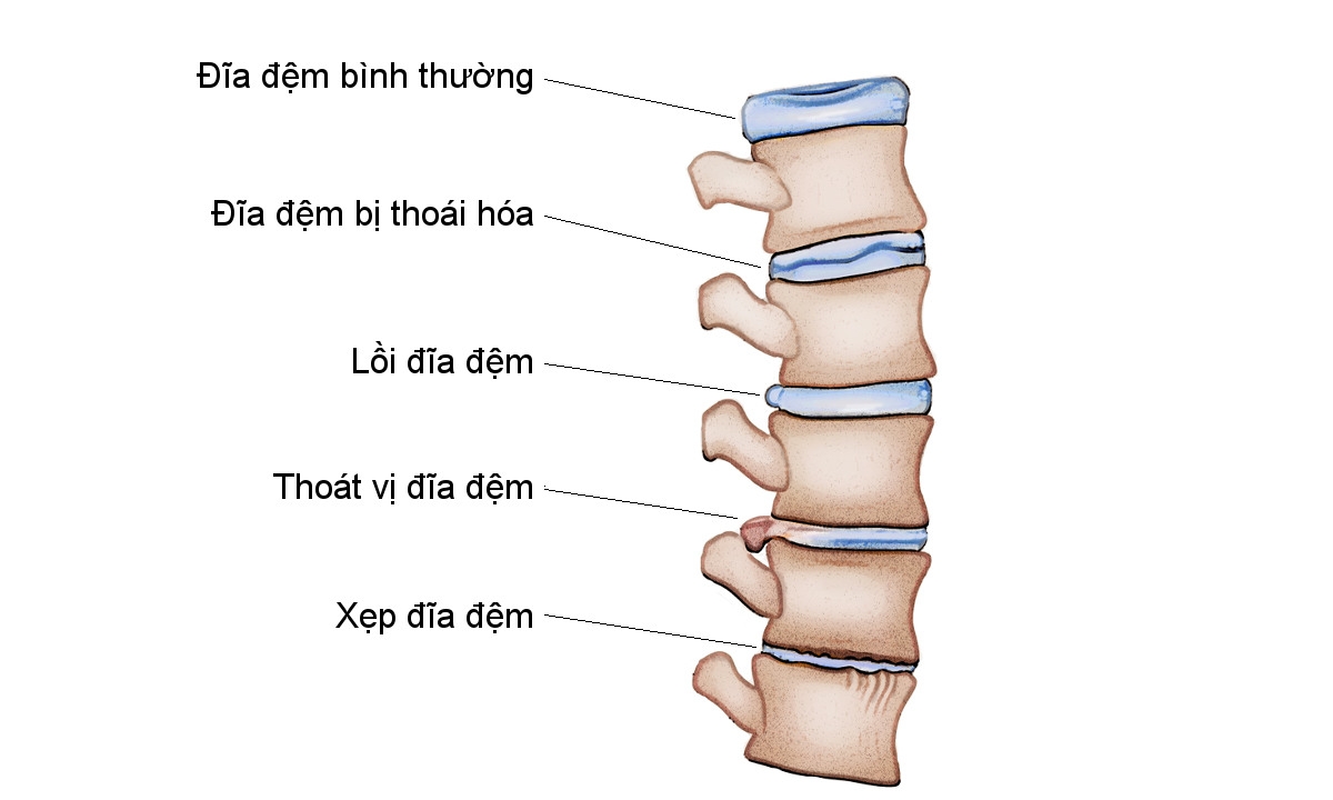 Bị thoái hóa cột sống nên uống sữa gì hiệu quả