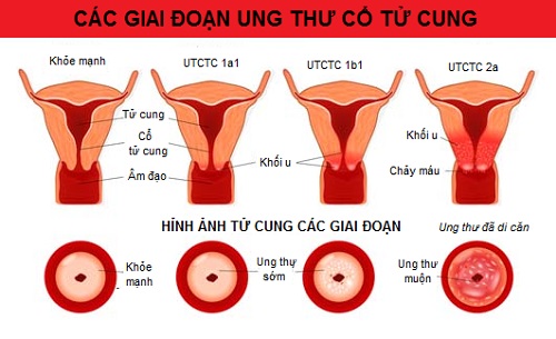 Bị ung thư có nên uống sữa đậu nành không