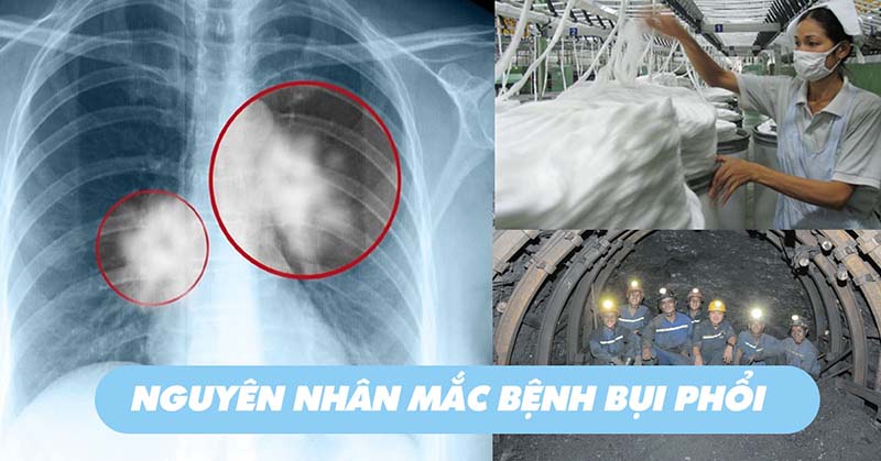 Biến chứng bệnh bụi phổi bông nghề nghiệp như thế nào