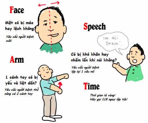 Biến chứng của tai biến mạch máu não là gì và cách phòng bệnh như thế nào