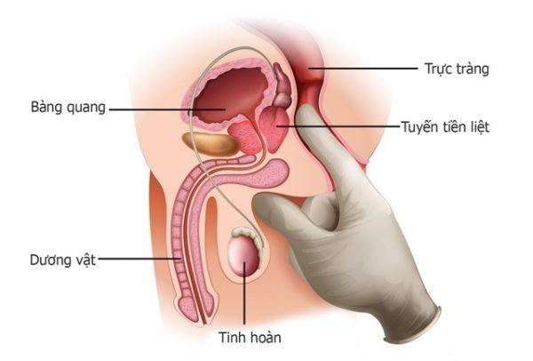 Biến chứng của viêm tuyến tiền liệt