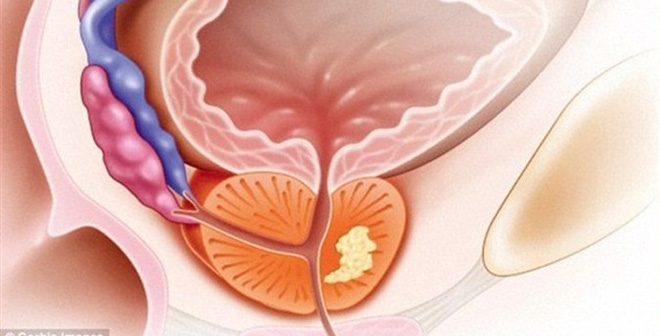 Biến chứng của viêm tuyến tiền liệt