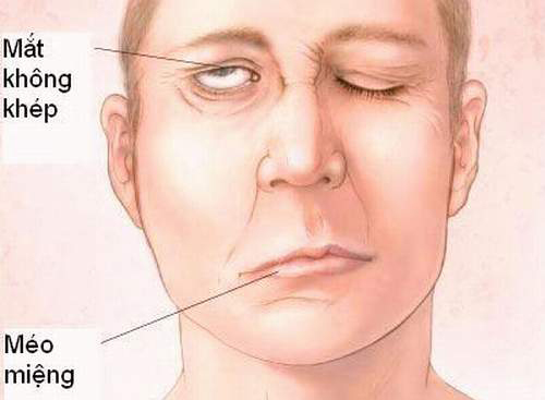 Biến chứng nhồi máu não như thế nào