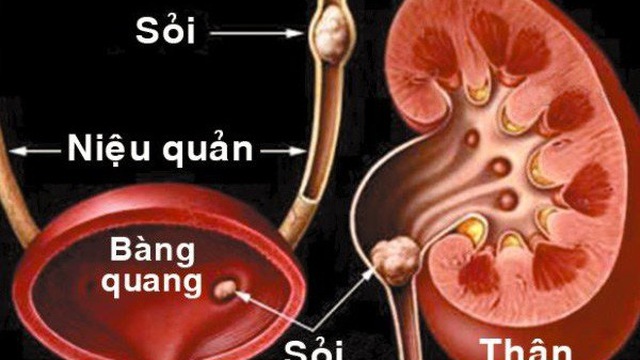 Biến chứng sau mổ sỏi niệu quản như thế nào 