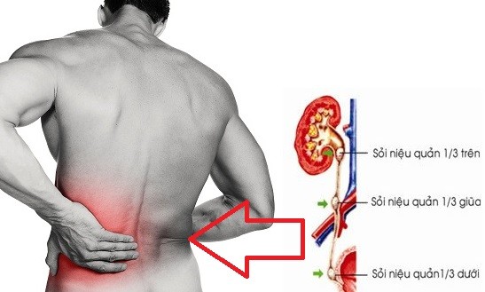 Biến chứng sau mổ sỏi niệu quản như thế nào 