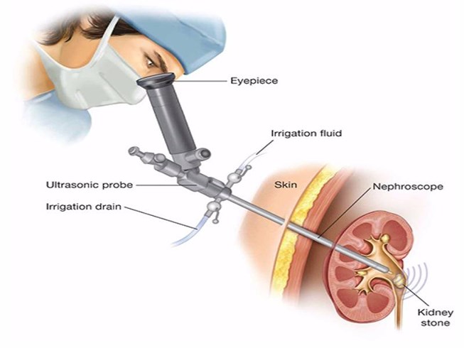 Biến chứng sau mổ sỏi thận như thế nào