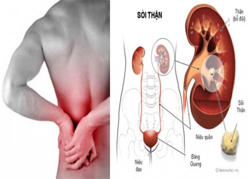 Biểu hiện của bệnh sỏi thận là gì và cách chữa trị ra sao
