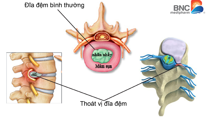 Biểu hiện thoát vị đĩa đệm