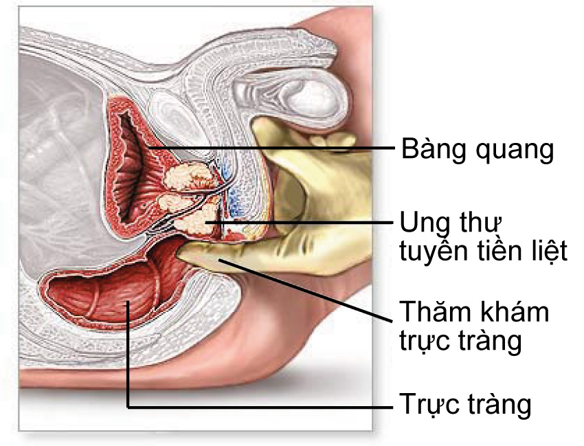 Biểu hiện viêm tuyến tiền liệt là gì và cách khắc phục ra sao