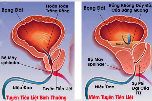 Biểu hiện viêm tuyến tiền liệt là gì và cách khắc phục ra sao