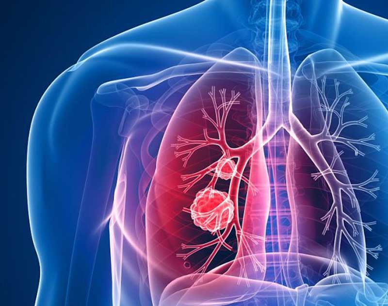 Bước tiến mới trong chẩn đoán và điều trị Ung Thư Phổi