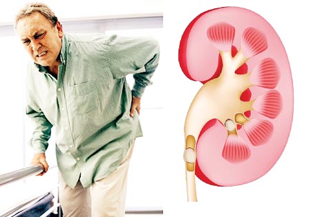 Các bài thuốc dân gian chữa sỏi thận an toàn hiệu quả