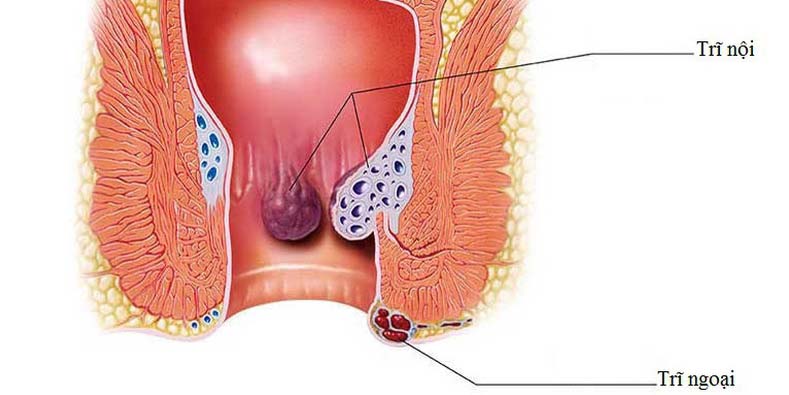 Các cấp độ của bệnh trĩ ngoại