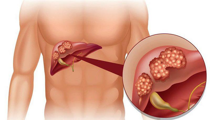 Các dấu hiệu ung thư gan giai đoạn đầu và cách phòng ngừa