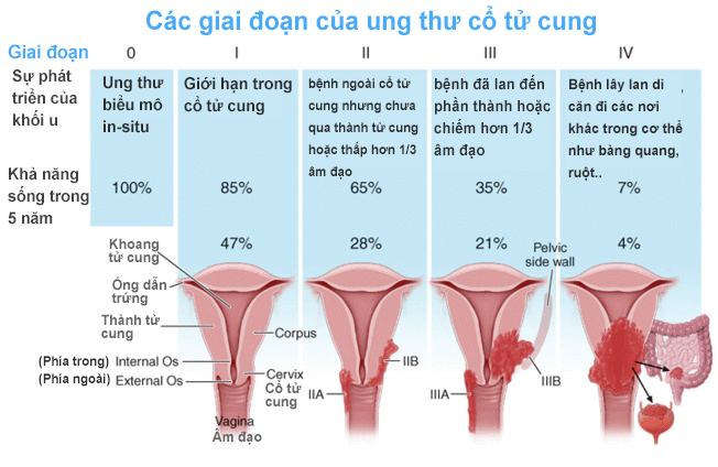 Các giai đoạn của ung thư cổ tử cung như thế nào
