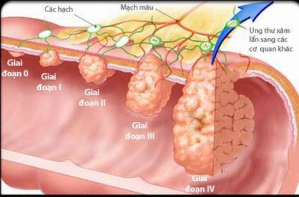 Các giai đoạn của ung thư dạ dày như thế nào