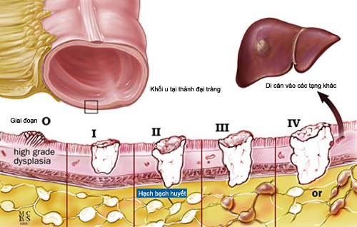 Các giai đoạn của ung thư đại tràng là gì và cách phòng bệnh ra sao