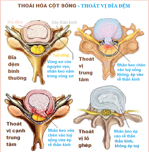thoát vị đĩa đệm nên ăn gì