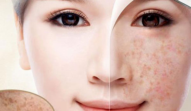 Các loại thuốc trị tàn nhang hiệu quả