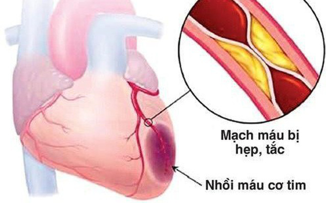 Các nhóm thuốc giảm lan rộng vùng trong nhồi máu cơ tim