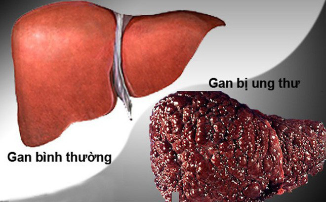 Các phương pháp điều trị ung thư gan giai đoạn cuối như thế