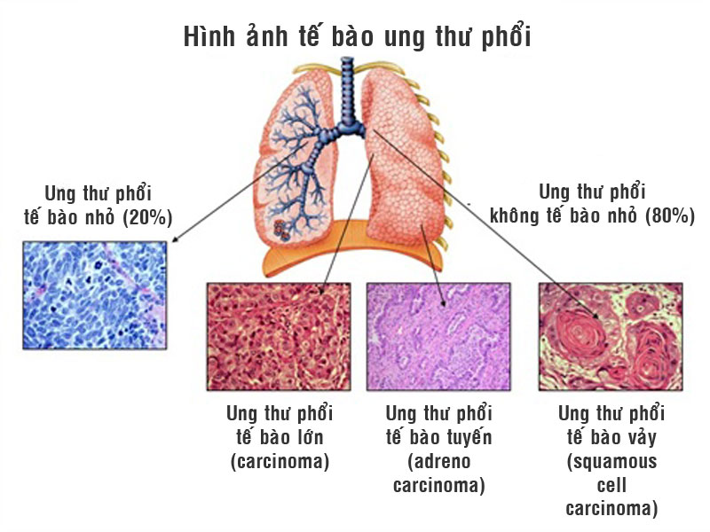 Các phương pháp điều trị ung thư phổi và cách phòng bệnh ra sao