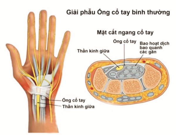 Cách bấm huyệt chữa hội chứng ống cổ tay như thế nào