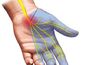 Cách bấm huyệt chữa hội chứng ống cổ tay như thế nào