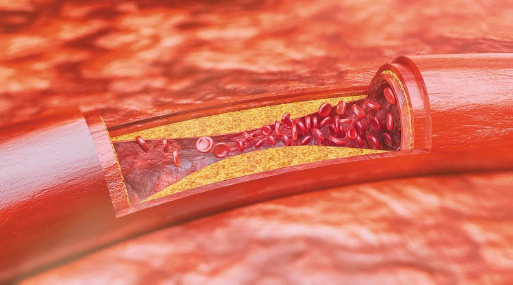 Cách chống xơ vữa mạch máu hiệu quả an toàn