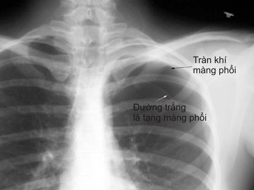 Cách chữa bệnh khó thở tại nhà an toàn hiệu quả 