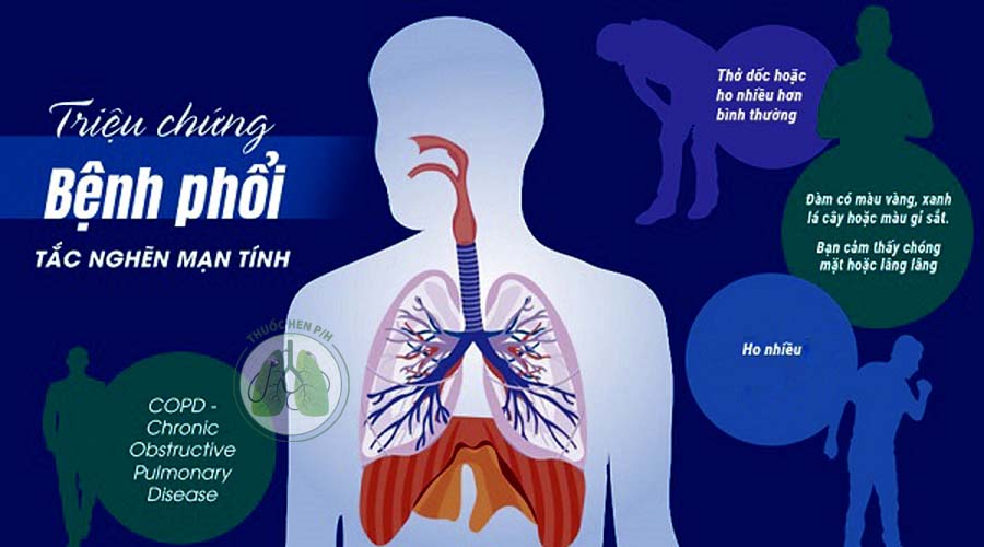 Thuốc điều trị bệnh phổi tắc nghẽn mạn tính an toàn hiệu quả
