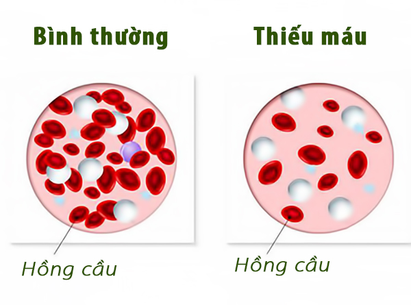 Cách chữa bệnh tiền đình như thế nào 