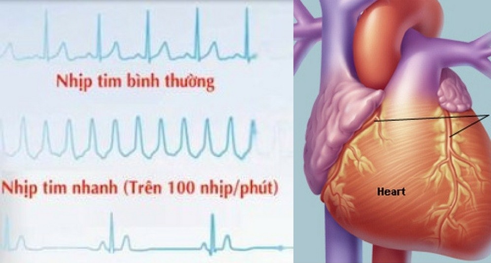 cách chữa bệnh tim đập nhanh an toàn hiệu quả