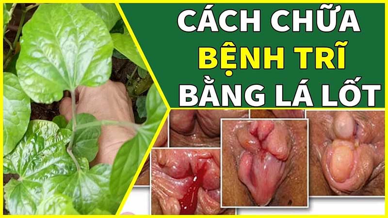Cách chữa bệnh trĩ bằng lá lốt như thế nào