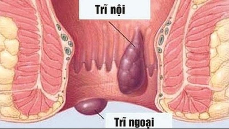 Cách chữa bệnh trĩ cấp độ 1 an toàn hiệu quả