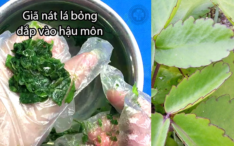 Cách chữa bệnh trĩ cho mẹ sau sinh