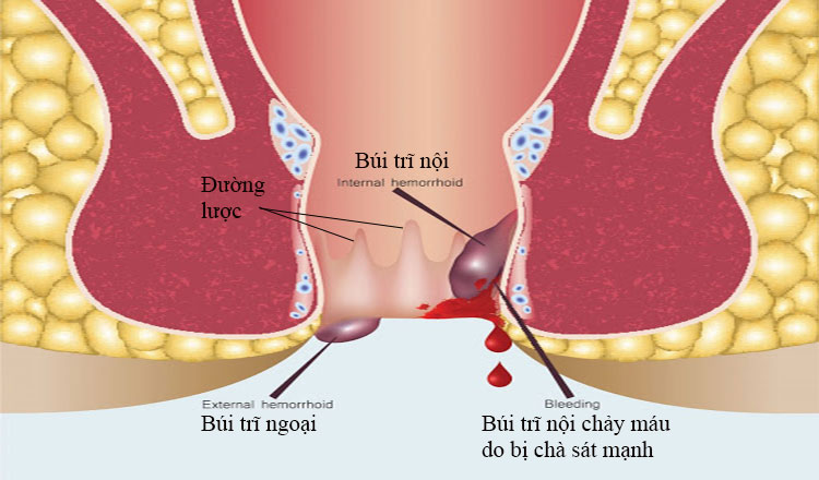 Cách chữa bệnh trĩ độ 2 an toàn hiệu quả
