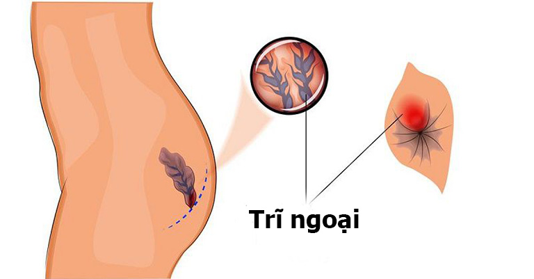 Cách chữa bệnh trĩ độ 2 an toàn hiệu quả