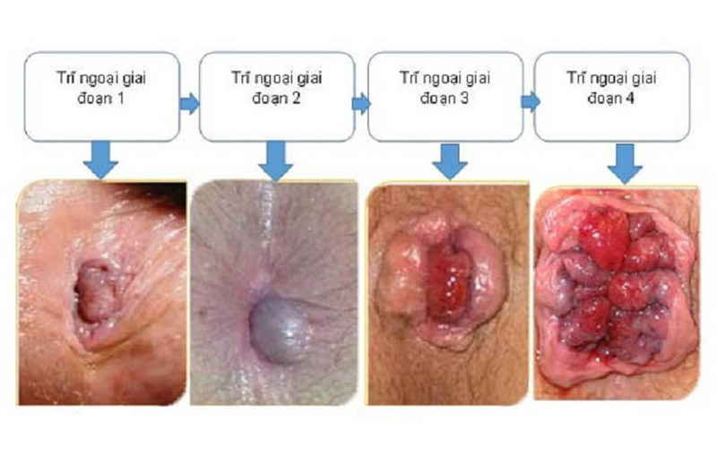 Cách chữa bệnh trĩ độ 3 an toàn hiệu quả