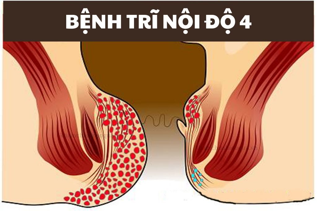 Cách chữa bệnh trĩ độ 4 an toàn hiệu quả