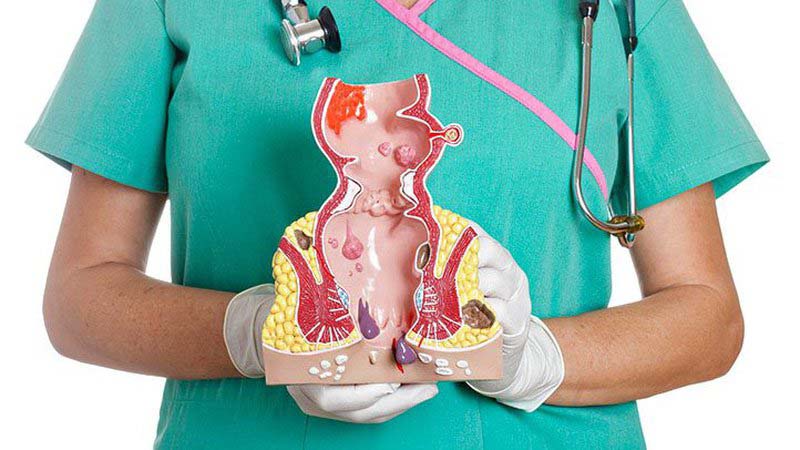 Cách chữa bệnh trĩ ngoại cấp độ 4 hiệu quả