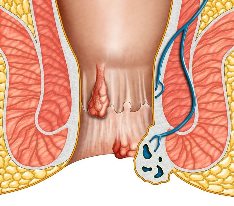 Cách chữa bệnh trĩ nhanh và hiệu quả nhất 