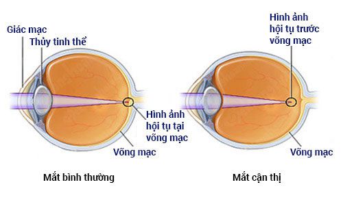 Cách chữa cận thị bằng cà chua an toàn hiệu quả