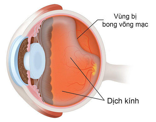 Cách chữa cận thị nặng tại nhà hiệu quả