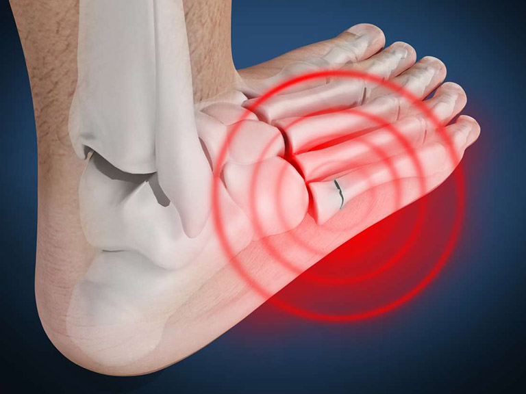 Cách chữa đau nhức bàn chân hiệu quả an toàn