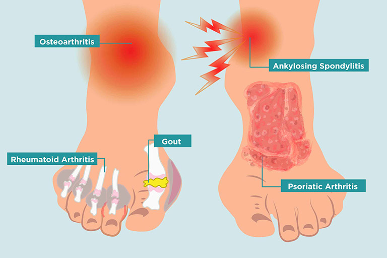 Cách chữa đau nhức bàn chân hiệu quả an toàn